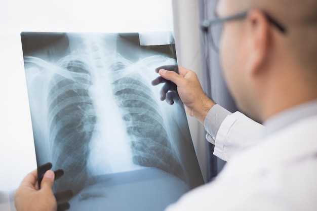 Рак легких на рентгене: особенности и диагностика