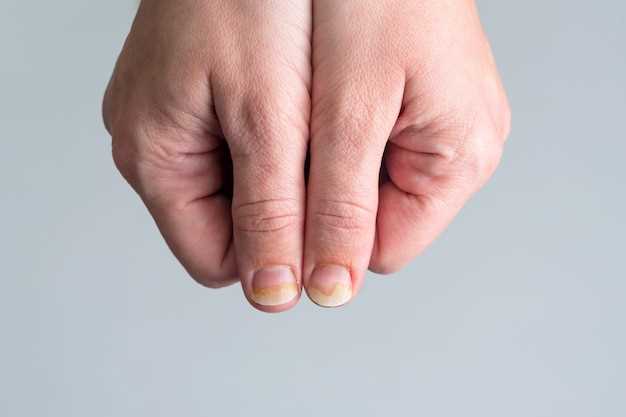 Причины отслаивания ногтевой пластины