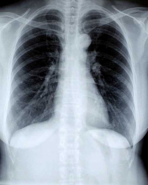 Описание снимка грудной клетки на рентгене: техника и особенности