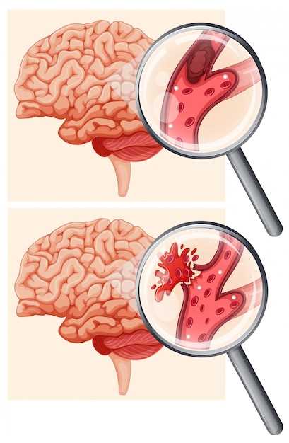 Опасные размеры ретроцеребеллярных кист головного мозга